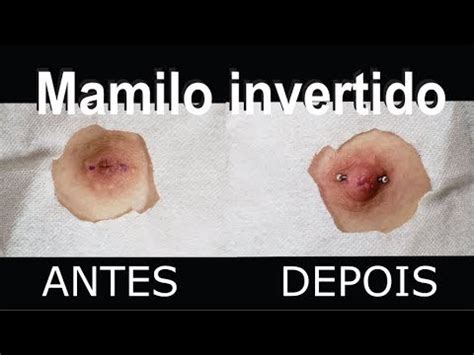 Mamilo Invertido